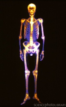 Coloured gamma scan of the human skeleton